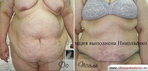 Операцию по абдоминопластике в Воронеже выполнил пластический хирург Николаенко Игорь Леонидович