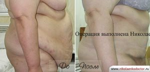 Операцию по липосации в Воронеже выполнил пластический хирург Николаенко Игорь Леонидович